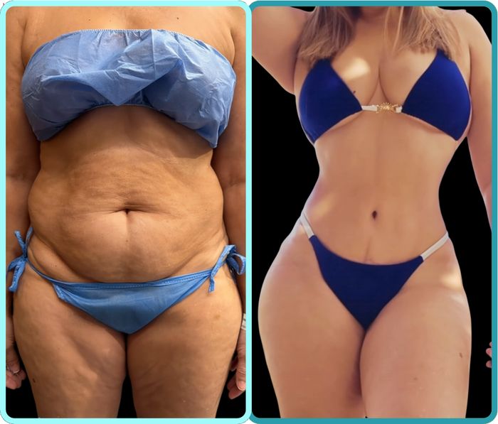 Abdominoplastia HD, antes y después