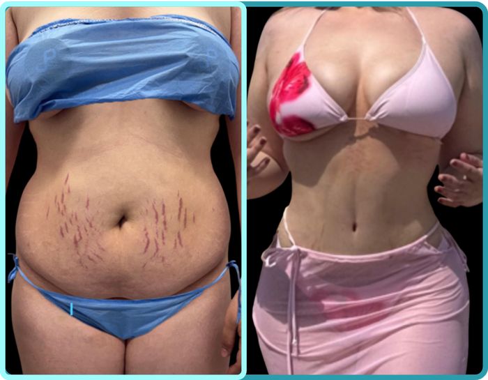 Abdominoplastia HD, antes y después