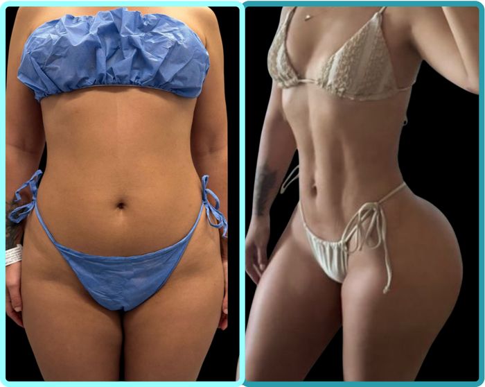 Fit Lipo, antes y después