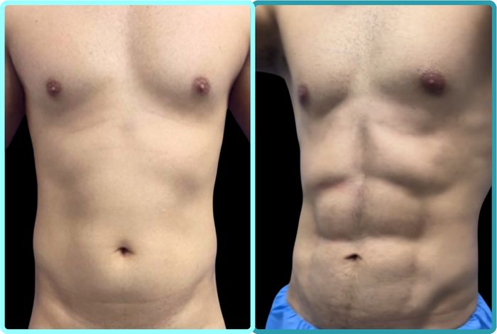 Fit Lipo en hombre, antes y después